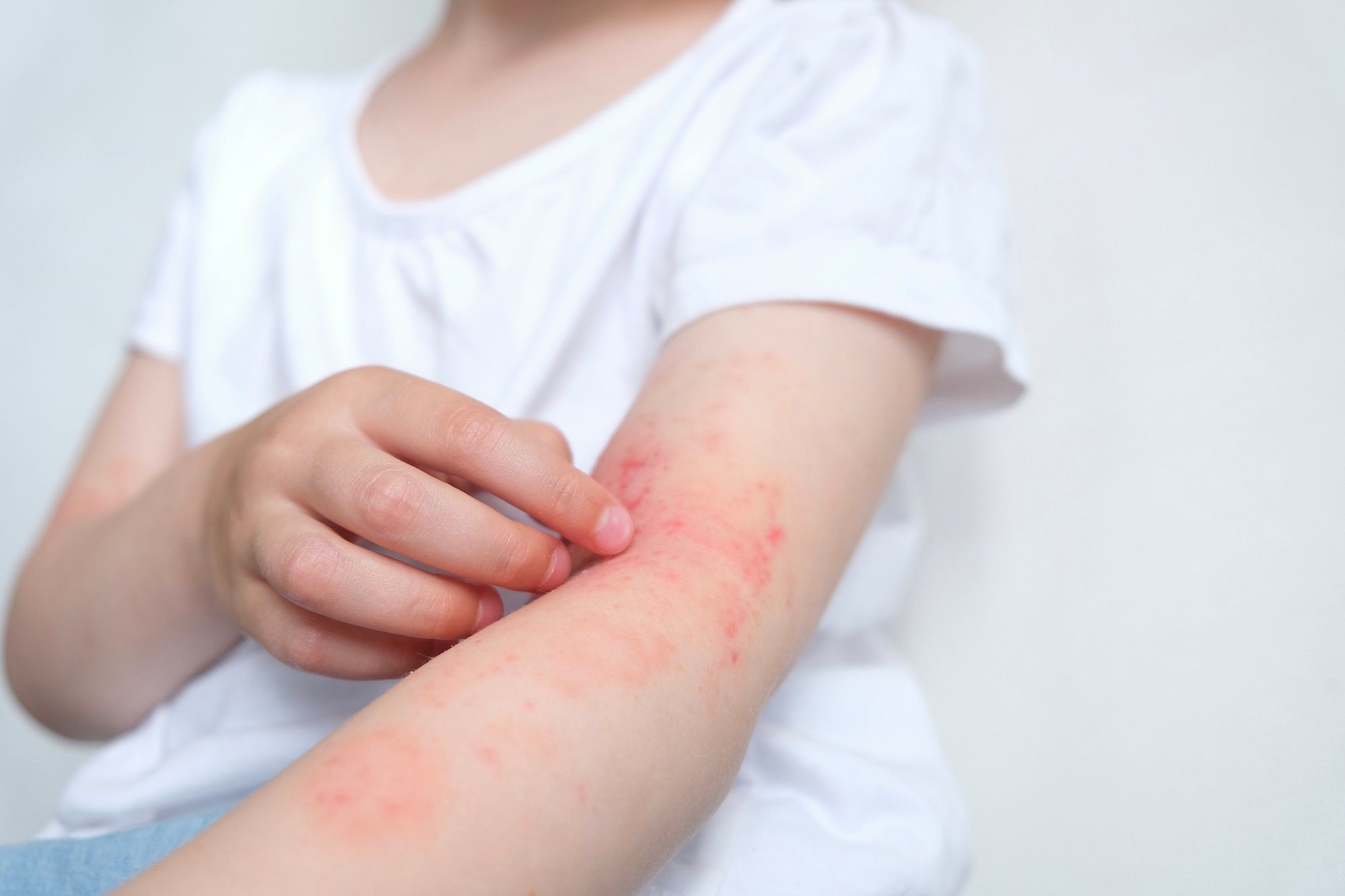 The Gut-Skin Connection: Probiotics in Paediatric Eczema